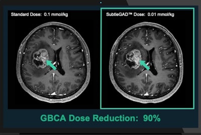 Subtle Medical claims that SubtleGAD can reduce gadolinium dosage by 90%. Image courtesy of Subtle Medical.