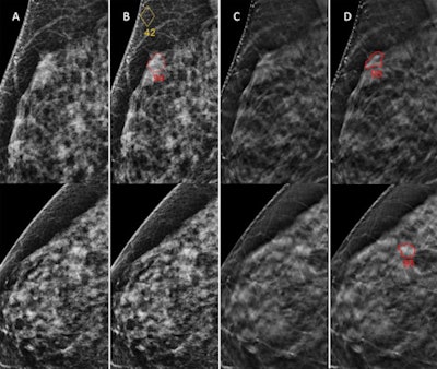 (A) Digital mammography (DM) and (B) digital breast tomosynthesis (DBT) images in a 66-year-old woman not recalled during any of the original readings. Artificial intelligence (AI) identified a spiculated mass (outlined) on images obtained with both techniques during screening and assigned a region score of 82 at DM and 95 at DBT. This woman would have automatically been recalled only at DBT. (C) DM image obtained four months later, after she discovered a palpable lump (not related to the actual cancer). Biopsy was performed, and an interval cancer, a grade II invasive ductal carcinoma of 6 mm, was diagnosed in the lesion that would have been recalled by AI. The AI examination score of this case was 10. Images and caption courtesy of the RSNA.