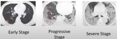 Various stages of COVID-19 shown on chest CTs from three different patients. Images courtesy of Maryellen Giger, PhD.
