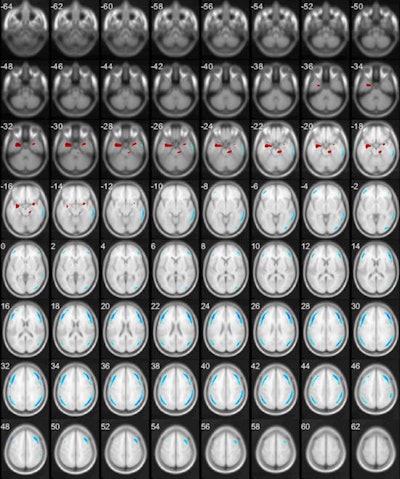 A map of significantly changed metabolic clusters in patients with major depression as compared with the control. Statistical parametric maps displayed on transverse sections depicting regions of hypermetabolic (red) and hypometabolic (blue) changes (Image courtesy of Plos One).
