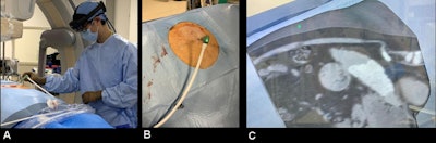 AR-assisted hepatic lesion microwave ablation using the Microsoft HoloLens 2 headset and Medivis SurgicalAR visualization system at OSHU. (A) Dr. Brian Park wearing the Microsoft HoloLens 2 headset during the procedure. (B) Reality visual signals through the operator's eyes. (C) Reality visual signals overlaid with AR 3D hologram generated from a preprocedural CT scan. All images and caption courtesy of Dr. Ningcheng 'Peter' Li.