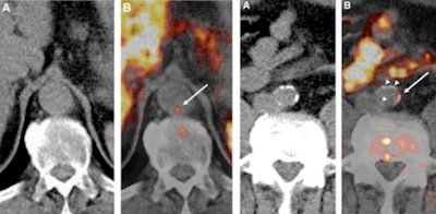 Examples of carbon-11 (C-11) acetate PET/CT of the aorta in patients receiving whole body scans for oncologic indications. Images from patient 1 (left panel, A and B) indicate C-11 acetate uptake in an aortic region without calcified plaques, whereas images from patient 2 (right panel, A and B) demonstrate colocalization of C-11 acetate uptake with aortic calcifications (white arrows point to areas of arterial C-11 acetate uptake).