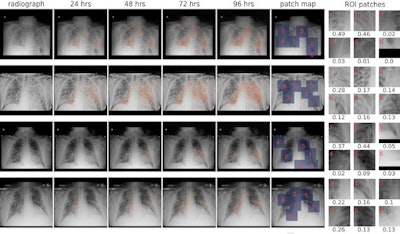From left to right: the original x-ray image; saliency maps for clinical deterioration within 24, 48, 72, and 96 hours; locations of region-of-interest (ROI) patches; and ROI patches with their associated attention scores. All four patients were admitted to the intensive care unit and were intubated within 48 hours. Image courtesy of npj Digital Medicine.