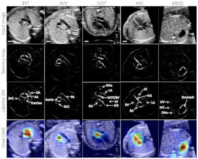 Example test image shown per view (top row), with corresponding saliency map (unlabeled, second row; labeled, third row) showing that the pixels most important to the model in predicting the view highlighted anatomic structures important to each view. Fourth row: gradient-weighted class activation map (Grad-CAM) provides a heatmap of regions of the image most important to the model in predicting the view. Grad-CAMs were also highly specific for structures distinguishing each view; the confluence of the aortic and ductal arches compared to the aortic cross-section distinguishing 3VT from 3VV, for example, and the left ventricular outflow tract versus right heart distinguishing A5C from A4C. SM = saliency map; 3VT = 3-vessel trachea; 3VV = 3-vessel view; A5C = apical 5-chamber; A4C = apical 4-chamber; ABDO = abdomen; DA = ductal arch; AA = aortic arch; SVC = superior vena cava; PA = pulmonary artery; TV = tricuspid valve; AV = aortic valve; MV = mitral valve; IVS = interventricular septum; IAS = interatrial septum/foramen ovale. Images and caption courtesy of Dr. Rima Arnaout.