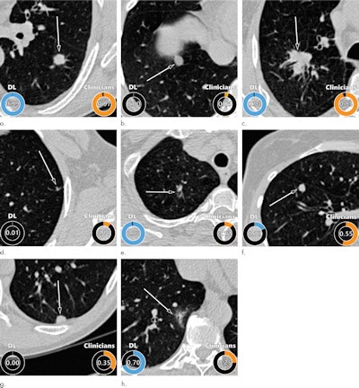 Examples of CT images in nodules from the Danish Lung Cancer Screening Trial