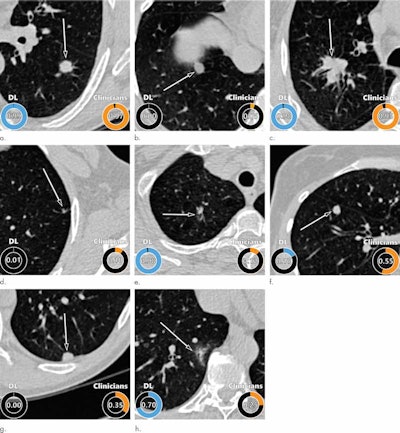 Examples of CT images in nodules from the Danish Lung Cancer Screening Trial with high and low agreement between the deep-learning algorithm and the clinicians for malignancy risk estimation