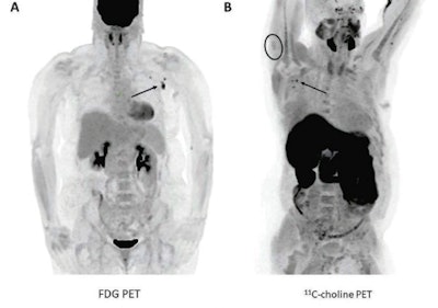 (A) A 57-year-old woman with right upper arm melanoma who received the first dose of the COVID-19 vaccine (Pfizer-BioNTech) in the left deltoid 15 days prior to FDG PET/CT. FDG uptake is observed within left axillary lymph nodes (arrow, SUVmax = 9.3). (B) A 62-year-old man with metastatic prostate carcinoma who received the second dose of COVID-19 vaccine (Pfizer-BioNTech) in the right deltoid seven days prior to C-11 choline PET/CT. Image courtesy of the American Journal of Roentgenology.