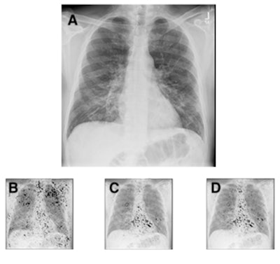 Chest radiograph (A) of a 63-year-old male patient with COVID-19 hospitalized for seven days, and with a body mass index of 26, demonstrating subtle ground-glass opacities in a lower lung distribution with increased geographic (0.34) and opacity scores (0.64). The integrated gradients saliency maps, with darker shades representing higher scores from the multitask comorbidity hierarchical condition category model: morbid obesity (B), congestive heart failure (C), cardiac arrhythmias (D). Much of the activation seen is outside the lung parenchyma, with notable activation of the axillary soft tissue for obesity (B) and heart for congestive heart failure and cardiac arrhythmias (C, D). The activations for congestive heart failure and cardiac arrhythmias are very similar, but they demonstrate subtle differences, with slightly greater activation at the left atrium and aortic knob (D), likely suggesting the associations of vascular disease and atrial fibrillation.