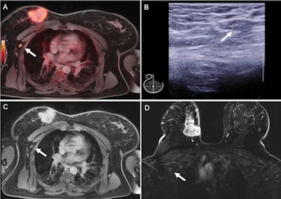 Pathologically confirmed axillary lymph node metastasis that was correctly identified on F-18 FDG PET/MRI (A) because of tracer uptake above background levels (SUVmax 4.3) and in axillary sonography (B) because of cortical enlargement to 3.8 mm (short-axis diameter 8 mm). This lymph node was rated unsuspicious on thoracic MRI (C) and breast MRI (C). Large primary cancer is seen in the right breast (D). Image courtesy of Journal of Nuclear Medicine.