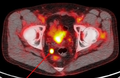 Image acquired with Pylarify demonstrates radiotracer uptake in right perirectal lymph node. Image courtesy of Lantheus.