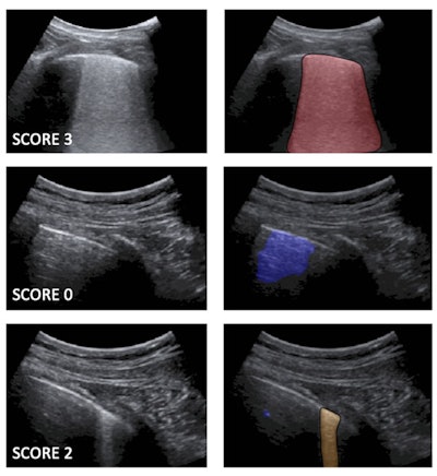 Left: Examples of lung ultrasound images corresponding to score 3 (top), score 0 (middle), and score 2 (bottom). Right: the corresponding semantic segmentations obtained with the described deep-learning algorithms. Color maps are informative of the score level (red for score 3, blue for score 0, orange for score 2), as well as indicate the relevant part of the image that determines the score. These maps explain the decision progress of the algorithms. Images and caption courtesy of Libertario Demi, PhD.