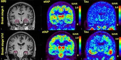 Comparisons of representative subjects. The first column highlights the hippocampus in pink on volumetric MRI. The second column shows early-frame amyloid PET (efAP) values from dynamic florbetapir-PET. The third column shows standard tau PET. Intensity scales for the PET images are shown as standardized uptake value ratios (SUVRs). Image courtesy of the Journal of Nuclear Medicine.
