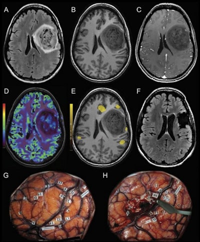 MRI scans and direct cortical stimulation technique in a 32-year-old woman with a grade II astrocytoma. Preoperative MRI shows a well-delineated mass within the left frontal lobe on (A) 3D fluid-attenuated inversion recovery (FLAIR) and (B) precontrast 3D T1-weighted scan. (C) Patchy and faint contrast enhancement is observed on postcontrast 3D T1-weighted MRI scan. (D) Cerebral blood volume map shows a globally hypoperfused tumor with hyperperfused foci. (E) Preoperative functional MRI indicates language responses surrounding the lesion. (F) Three-month postoperative FLAIR image shows complete resection of the tumor. (G) Intraoperative direct cortical stimulation helped confirm the presence of language areas (labels 10-15) in the vicinity of the tumor (demarcated by letters A-H). (H) Resection was performed according to the functional landmarks. After the surgical procedure, the patient presented with mild aphasia that completely regressed three months later. Image and caption courtesy of the RSNA.