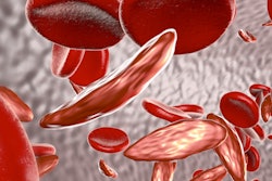 2021 06 04 16 23 3894 Sickle Cell Anemia2 400