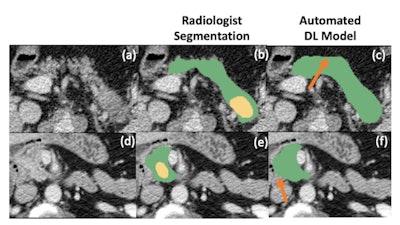 Radiologist’s segmentations (b,e) vs model-predicted automated pancreas segmentation (e,f). Orange arrows indicate mild relative oversegmentation of peripancreatic fat (c) and duodenum (f). The areas of tumor are highlighted with yellow overlay (b,e). The original cropped versions of the CT image are also provided for reference (a,c). Images and caption courtesy of Panagiotis Korfiatis, PhD.