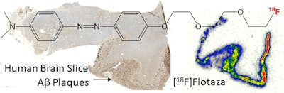 Human Alzheimer's disease brain section showing binding of F-18 Flotaza to beta-amyloid plaques. Image courtesy of Bioorganic & Medicinal Chemistry Letters.