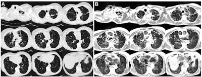 Axial multisection imaging yielded full lung coverage using (A) CT (reformatted to 0.8 x 0.8 x 6 mm) and (B) T2-weighted MRI (1.1 x 1.1 x 6 mm) in a 69-year-old woman with bronchiectasis, cavitary lesions, and scattered pulmonary nodules. Images and caption courtesy of the RSNA.