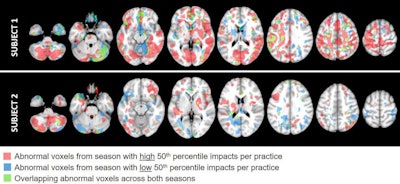 Brain MRI scans of two football players who experienced a different number of head impacts during their seasons. Subject 1 experienced more head impacts during the season, as indicated by more abnormal voxels on diffusion-tensor MRI scans of white matter compared with subject 2. Image and caption courtesy of the American Association of Neurological Surgeons (AANS).