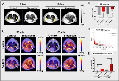 (A) Axial CT images through the mouse lungs at seven and 14 days after intratracheal administration of bleomycin or saline (as a control), demonstrating increased lung fibrosis in the bleomycin group (white arrows). (B) CT attenuation histograms in Hounsfield units (HU) after lung segmentation demonstrate increased attenuation in the lungs in the bleomycin group than the control group (p < 0.05), consistent with increasing fibrosis (n = 3). (C) Representative axial PET/CT fusion images at 20 and 60 min demonstrating increased FAPI uptake in the lungs of the bleomycin group (white arrows) with no significant uptake in the control group (yellow arrows). (D) Time-activity curve of lung uptake ROI analysis demonstrating higher FAPI uptake in the lungs of the bleomycin group than the control (p < 0.05), 14 days after bleomycin (n = 3). (E) Ex vivo biodistribution data of lung tissue demonstrating higher radiotracer uptake in the lungs of the bleomycin group than the control (n = 3). Images and caption courtesy of the SNMMI.