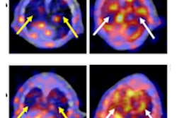 2021 06 11 20 07 9442 2021 06 14 Snmmi Lung Fibrosis 400