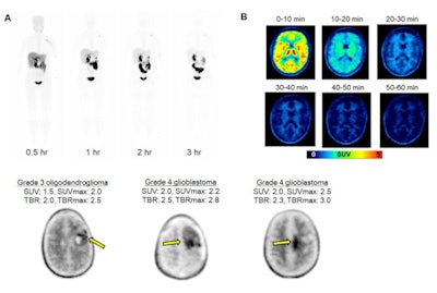 Clinical evaluation of F-18 DASA-23. (A) Whole-body PET maximum-intensity-projection images at different time points after F-18 DASA-23 administration in a healthy volunteer. (B) Representative axial F-18 DASA-23 PET images of a healthy human brain at various summed time points after tracer administration. (Bettom row) Representative 30-60 minute summed F-18 DASA-23 PET images in patients with intracranial malignancies. Standardized uptake values (SUV) and tumor-to-brain (TBR) values are shown. Images courtesy of SNMMI.
