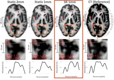 Result of the Hoffman brain phantom study. Top row: same PET slice reconstructed with 2-mm static ordered subset expectation maximization (OSEM), (B) 1-mm static OSEM, proposed superresolution (SR) method, and corresponding CT slice (note that the CT image can be treated as a high-resolution reference). (Middle row) Zoom on region of interest for corresponding images. (Bottom row) Line profiles for corresponding data. Image courtesy of Yanis Chemli.