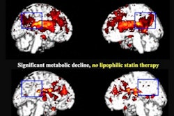 2021 06 14 23 48 2139 2021 06 15 Statin Brains 400
