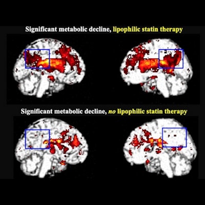 2021 06 14 23 48 2139 2021 06 15 Statin Brains 400