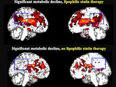 Significant metabolic decline in the posterior cingulate cortex in lipophilic statin users after five to six years (top) compared with hydrophilic statin users and those not taking statins (bottom). Image courtesy of Prasanna Padmanabham.