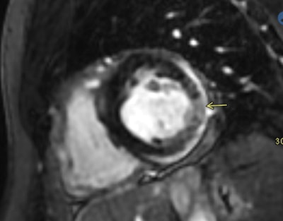 Additional case of myocarditis in a young male (26-30 years old) presenting to the hospital three days after a second mRNA Covid vaccine. The patient underwent a cardiac MR ten days post vaccine; images above show a focal area of edema and delayed enhancement in the mid-inferolateral segment. There is also a trace pericardial effusion with enhancement of the pericardium indicating pericarditis in addition to the myocarditis. Images courtesy of Dickey team co-author Dr. David Gerson of University of Massachusetts Medical School in Worcester.