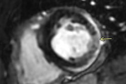 2021 06 17 15 09 5933 2021 06 17 Covid Vaccine Myocarditis 20210617161921