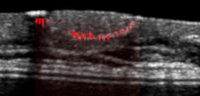 Microcalcifications in a blood vessel in the breast. Image courtesy of UltraVision.