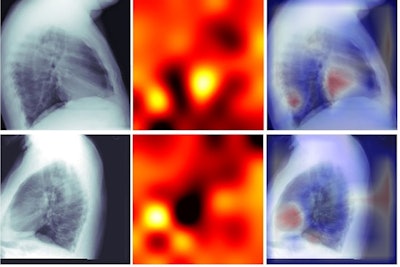 Lateral chest radiographs labeled with total Agatston scores. Despite training only on calcium score numbers, algorithms learned to focus on and prioritize the cardiac silhouette to predict the presence of coronary artery calcium. Left column, radiographs; middle column, attention-based heat maps; right column, heat maps overlaid on radiographs. Image courtesy of Radiology: Cardiothoracic Imaging.