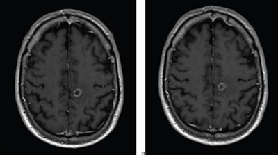 Axial T1-weighted MR images obtained using (A) standard-dose gadoterate and (B) reduced-dose gadobutrol four days later. Mean score across three readers for standard-dose gadoterate and reduced-dose gadobutrol was 3.4 and 3.4, respectively, for subjective lesion enhancement; 3.5 and 3.4, respectively, for lesion border delineation; and 2.9 and 2.9, respectively, for lesion internal morphology. Image and caption courtesy of the ARRS.