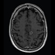 2021 06 18 23 46 7709 2021 06 17 Reduced Dose Brain Mri 400