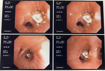 Image of aspirated dental crown captured using a flexible bronchoscope and clamp.