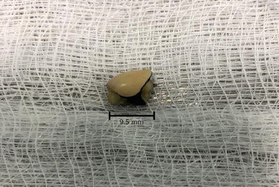 The removed 9.5-mm prosthetic dental crown.