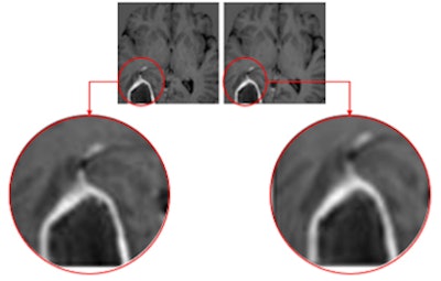 IB Zero G AI software images; (left) standard contrast and (right) zero contrast. Images courtesy of Imaging Biometrics.