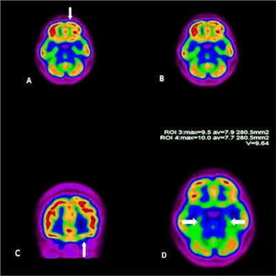 FDG-PET/CT scan of a 27-year-old woman with persistent anosmia and positive PCR test for SARS-CoV-2. Representative axial (A, B, D) and coronal (C) images are shown. There was decreased uptake in the left orbitofrontal cortex (arrows). The uptake of temporal lobes were symmetric and normal (arrows, D). Image courtesy of Academic Radiology.