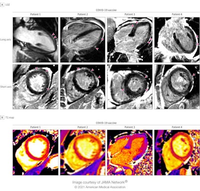 Cardiac MRI scans of patients with acute myocarditis following COVID-19 vaccination. Late gadolinium enhancement (LGE) images and T1 maps are shown in four patients who recently received a COVID-19 vaccine. Patients 1, 2, and 4 demonstrate epicardial LGE, and patient 3 demonstrates patchy, diffuse LGE (pink arrowheads), which are consistent with myocarditis. T1 maps demonstrate abnormal (elevated) native T1 in the regions with late gadolinium enhancement (blue arrowheads). Image and caption courtesy of JAMA Cardiology.