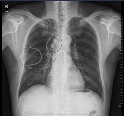 Vuno's Vuno Med-Chest AI algorithm will be embedded on Samsung's GM85 mobile x-ray system. Image courtesy of Vuno.