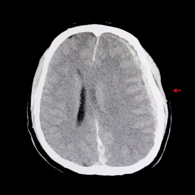 2021 03 04 00 11 9158 Ct Brain Hemorrhage Edema 400