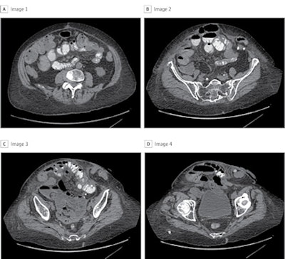 To capture the entire hernia defect for this patient, a total of 22 images were included for the development of the deep-learning model. Panels A through D are four representative CT cuts in order from cranial to caudal. Images and caption courtesy of JAMA Surgery.