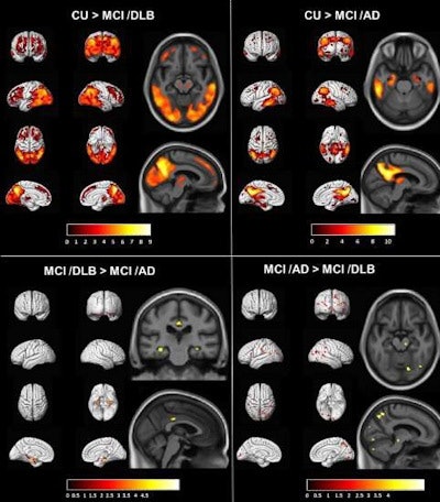 Voxel-based analysis comparing standardized uptake value ratio (SUVr) on FDG-PET scans of patients with mild cognitive impairment and dementia with Lewy bodies (MCI-DLB), mild cognitive impairment and Alzheimer's disease (MCI-AD), and clinically unimpaired (CU) controls. Maps of these comparisons were displayed at the p < 0.001 level with the t-values displayed in the color bar. The voxel-based regional differences in FDG SUVr in MCI groups compared to controls were corrected for multiple comparisons using family-wise error correction. Because there were no differences identified between the MCI-DLB and MCI-AD groups after correction for multiple comparisons, the uncorrected results are displayed. Image courtesy of NeuroImage: Clinical.