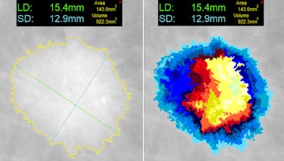 At left, one-click segmentation and measurement rendered by DL Precise. At right, DL Precise uses vivid color to illustrate segmentation. Image courtesy of DL Precise.