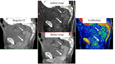 Sagittal pelvis spectral CT scan of 65-year-old man with rectal adenocarcinoma. Conventional CT scan shows apparent hyperenhancing tumor that extends from the midrectum (small arrow) to the distal rectum (large arrow). However, the iodine map reveals iodine enhancement only involves the midrectum and spares the distal rectum. The water map confirms that the hyperdensity of the distal rectum is due to noniodine-containing radiodense stool. The z-effective image further shows that enhancing tumor only involves the midrectum and not the distal rectum. This case illustrates the value of spectral CT over regular CT to improve clinical tumor staging by differentiating between ambiguous densities. Image courtesy of Dr. Benjamin Yeh.