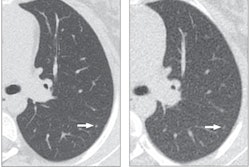2021 07 09 20 12 2044 2021 07 09 Ct Kids Lung Nodules 400