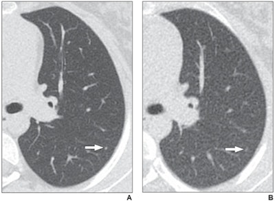 Axial reformatted clinical (1.083 mSv) and reduced dose (0.318 mSv) CT images from a 17-year-old girl with osteosarcoma. A 2-mm left lower lobe nodule is clearly visible in the left lower lobe on the clinical CT image (arrow in A). The same nodule is vaguely apparent on the reduced-dose CT image (arrow in B), classified as present but poorly visible. Images and caption courtesy of the American Journal of Roentgenology.