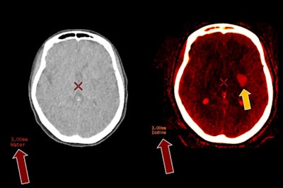 CT hyperdensity in left basal ganglia following thrombectomy could be iodine staining or postprocedure hemorrhage (Figure 1). Dual-energy iodine/water separation with signal only on the iodine map confirms iodine staining, allowing the patient to be anticoagulated following the procedure (Figure 2). Image courtesy of Dr. Greg Avey, associate professor, University of Wisconsin-Madison.