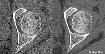 Images from female with suspected femoroacetabular impingement. Images were acquired with a state-of-the-art clinical CT system using a conventional energy-integrating detector (left) and a research CT system using a photon-counting detector CT capable of 125-micron spatial resolution (right). Higher spatial resolution of the photon-counting detector allows improved depiction of bone trabeculae. Image courtesy of Mayo Clinic.